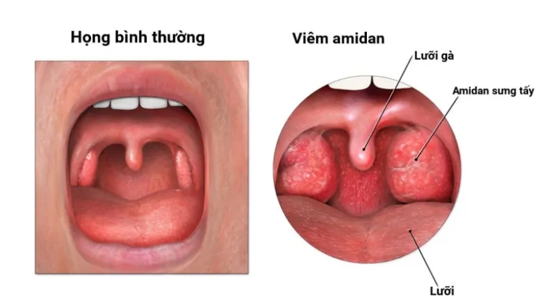 Viêm amidan ăn gì nhanh khỏi?