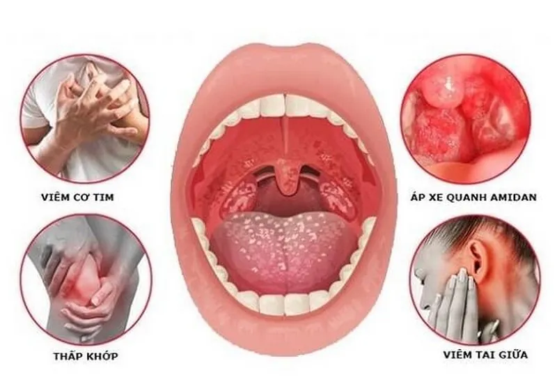 Viêm Amidan hốc mủ kiêng ăn gì?