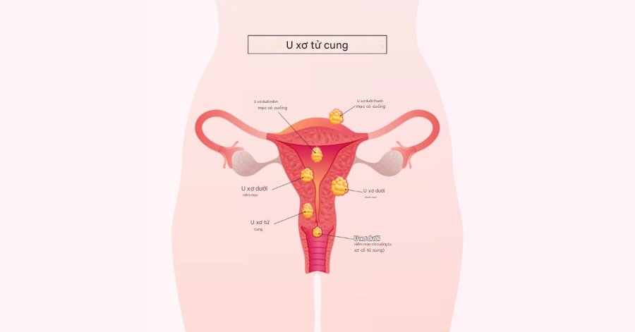 U xơ tử cung: Nguyên nhân, dấu hiệu và cách phòng ngừa hiệu quả