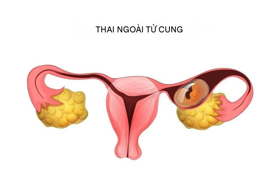 Máu báo có thai ngoài tử cung như thế nào? Dấu hiệu sớm mẹ cần nhận biết 