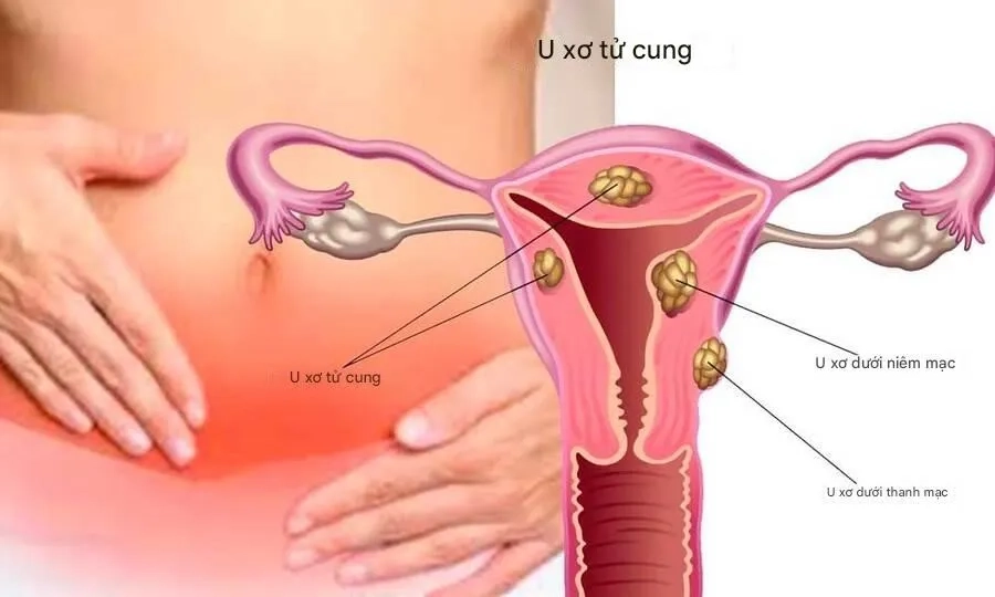 Giải mã nguyên nhân u xơ tử cung ở phụ nữ tuổi sinh sản