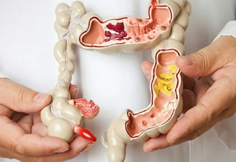 Ung thư đại tràng giai đoạn 1 nên ăn gì?
