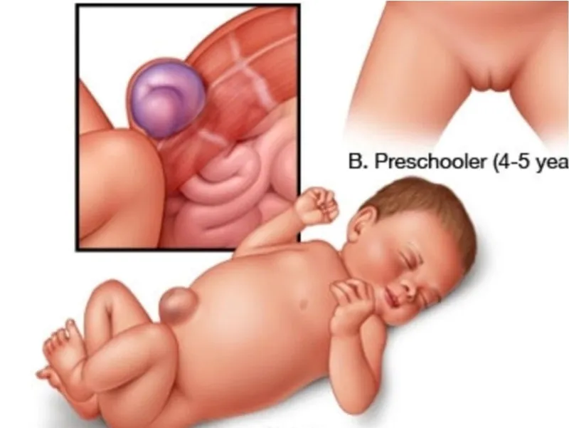 Thoát vị rốn ở trẻ sơ sinh có tự khỏi không?