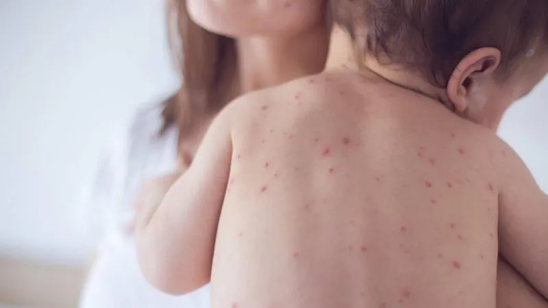 Trẻ bị phát ban sau sốt cần kiêng gì?