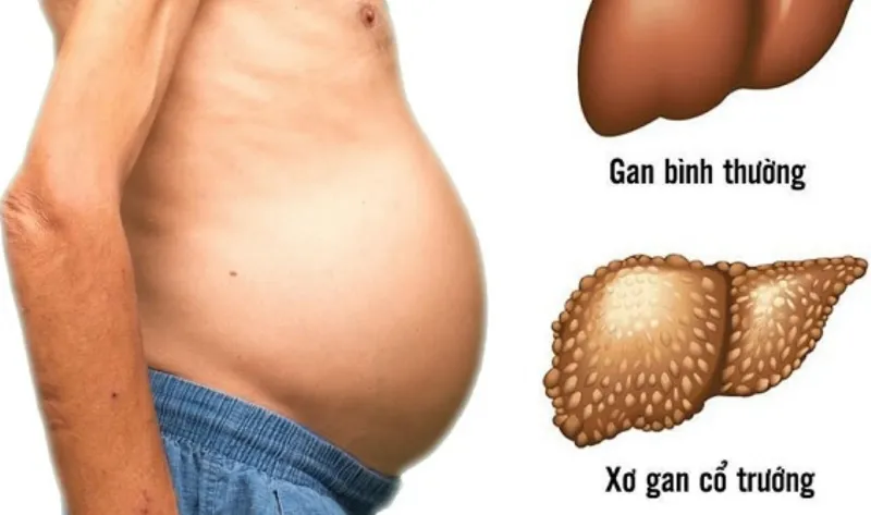 Xơ gan do rượu có chữa được không?