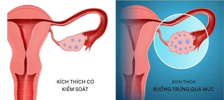 Quá kích buồng trứng: Nguyên nhân, dấu hiệu và hướng điều trị