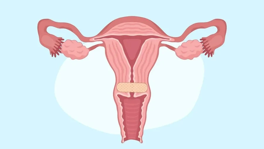 Viêm cổ tử cung là gì? Nguyên nhân, triệu chứng, điều trị và cách phòng ngừa hiệu quả