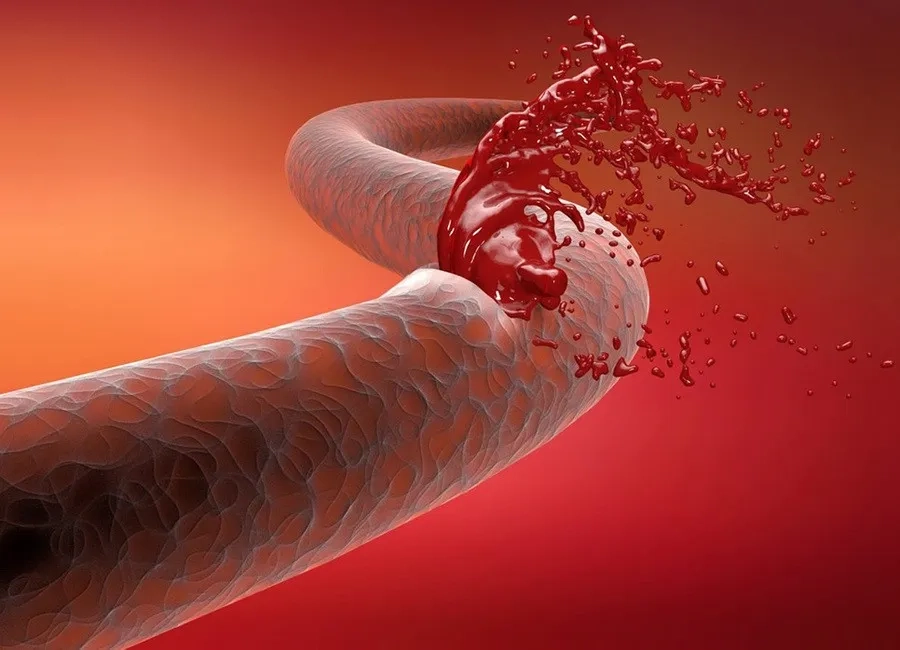 Máu khó đông Hemophilia A và B: Nguyên nhân, triệu chứng và cách phòng ngừa hiệu quả 