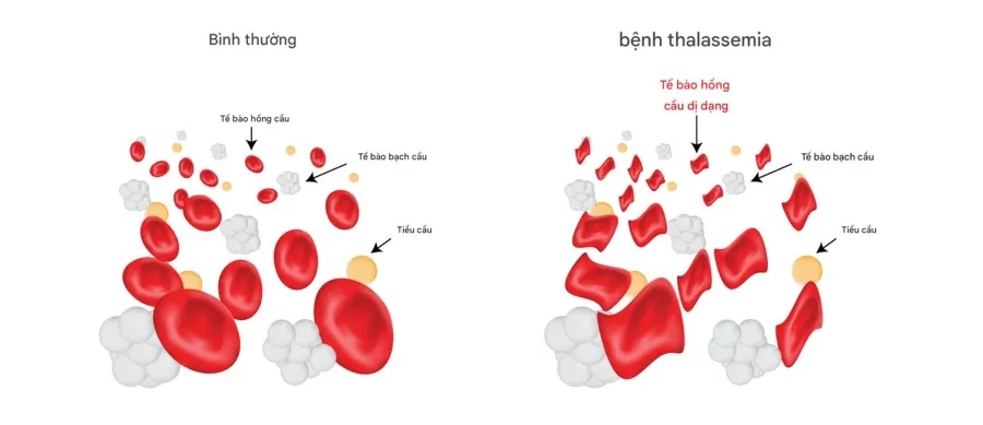 Tìm hiểu nguyên nhân bệnh tan máu bẩm sinh Thalassemia và yếu tố nguy cơ thường gặp