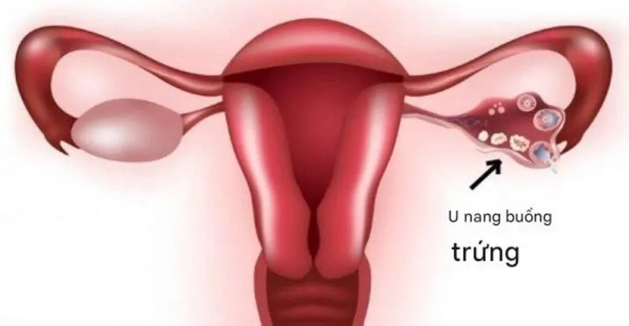 U nang buồng trứng phải: Nguyên nhân hình thành và mức độ nguy hiểm