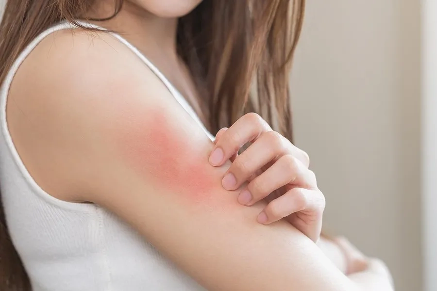 Sốt xuất huyết bị ngứa: Có nguy hiểm không và làm sao để giảm khó chịu?
