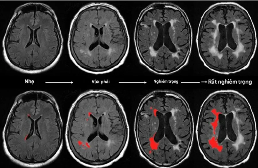 Loạn dưỡng chất trắng thượng thận liên kết X (X-ALD): Nguyên nhân, triệu chứng và phương pháp điều trị hiệu quả
