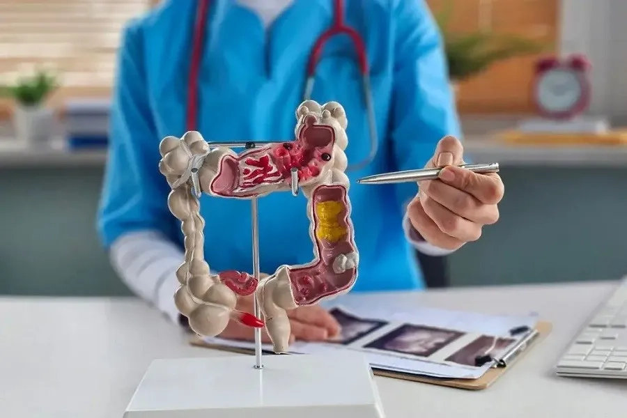 Ung thư đại tràng giai đoạn 4: Dấu hiệu, tiên lượng và cách điều trị