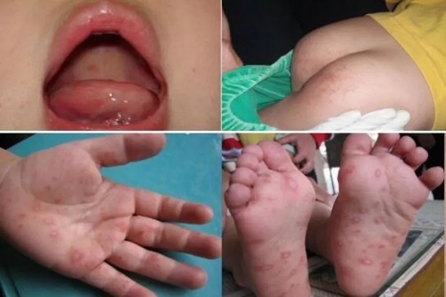 Trẻ bị tay chân miệng nhưng không sốt có nguy hiểm không? Cách nhận biết và chăm sóc tại nhà