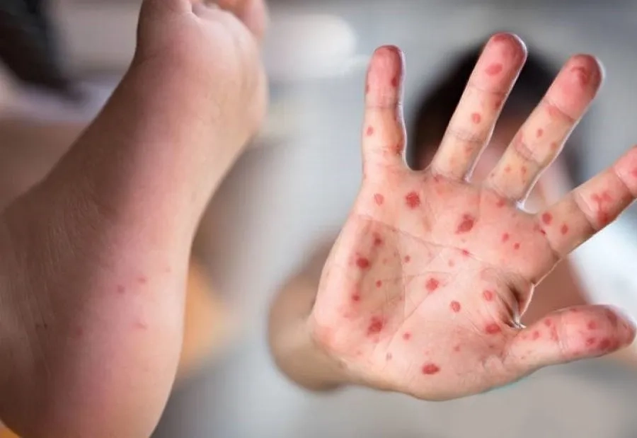 Virus Tay Chân Miệng Là Gì? Nguyên Nhân, Dấu Hiệu Và Cách Phòng Ngừa Hiệu Quả Ở Trẻ Nhỏ