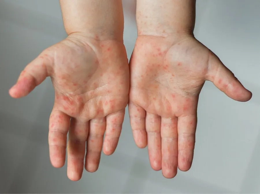 Trẻ Bị Tay Chân Miệng Có Được Tắm Không? Bác Sĩ Nhi Khoa Giải Đáp