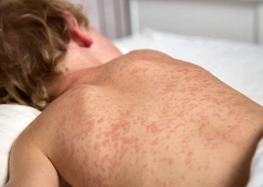 Nguyên nhân gây bệnh sởi, yếu tố nguy cơ và cách phòng ngừa