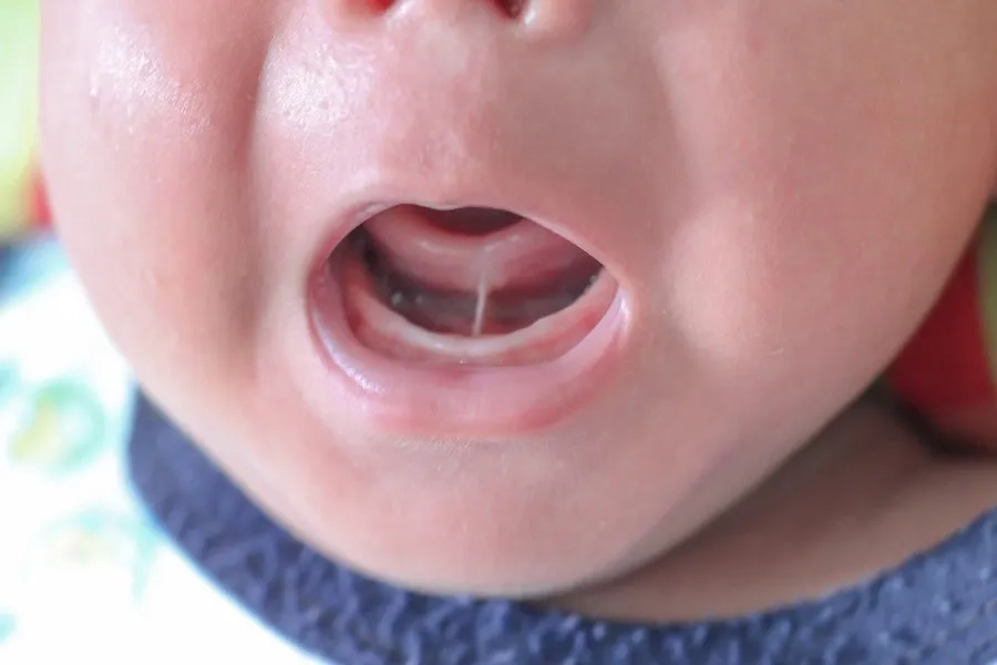 Dính thắng lưỡi độ 4 có cần cắt không? Dấu hiệu cần điều trị sớm