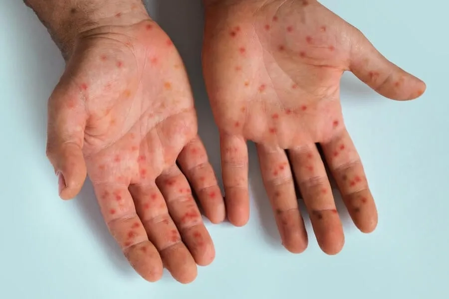 Biến chứng của bệnh sởi: Nhận biết sớm để hạn chế diễn tiến nặng