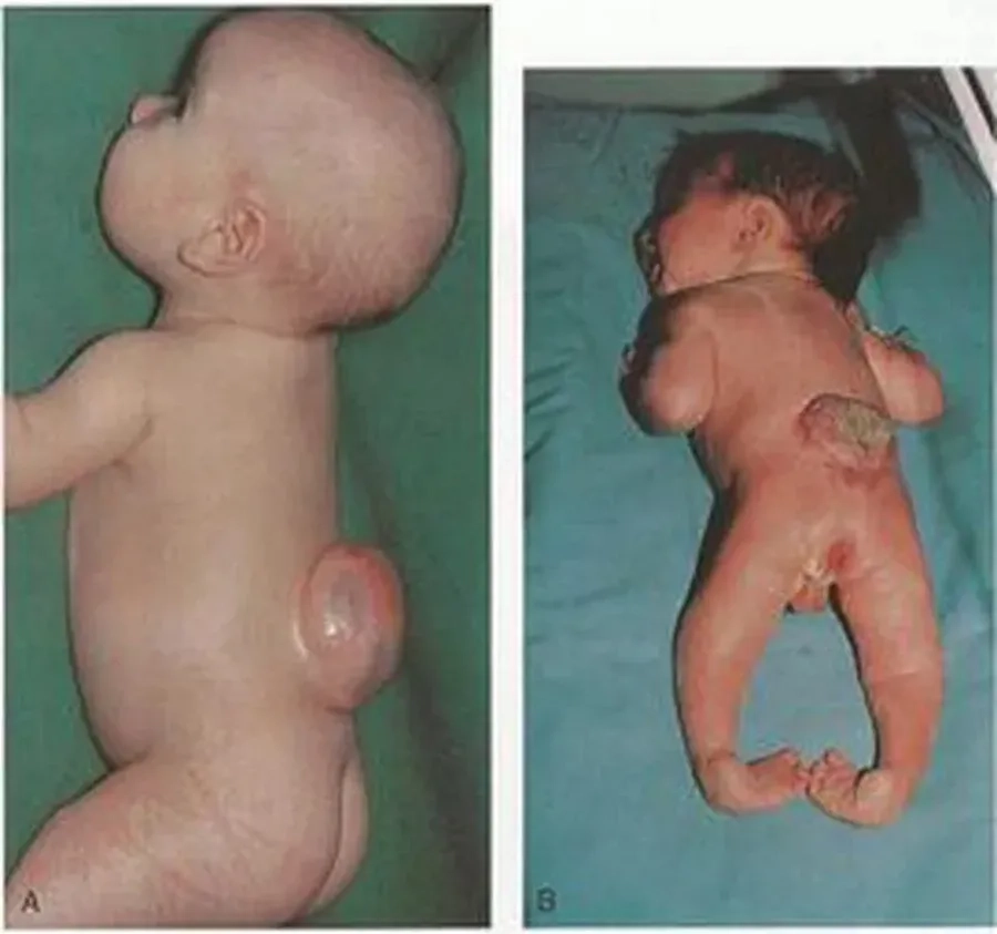 Nứt đốt sống (Spina bifida) là gì? Nguyên nhân, dấu hiệu và cách chẩn đoán sớm