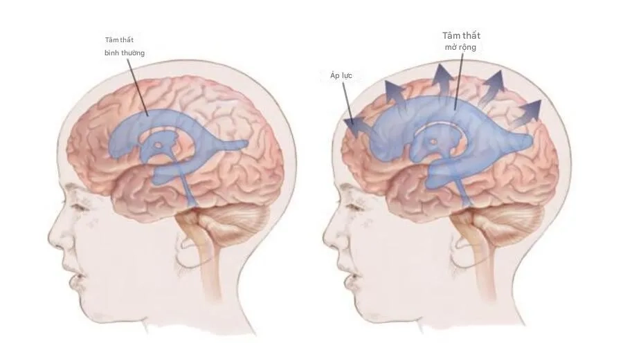 Não úng thủy (Hydrocephalus): Nguyên nhân, dấu hiệu nhận biết và các phương pháp điều trị an toàn hiện nay