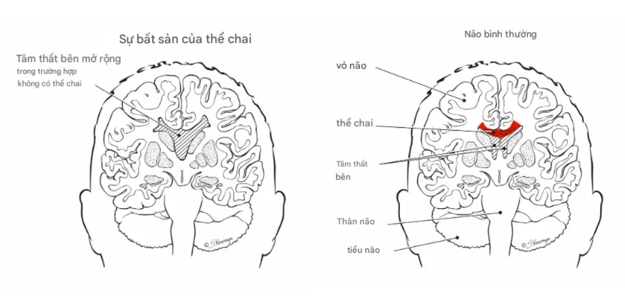 Bất sản thể chai là gì? Nguyên nhân, dấu hiệu nhận biết và cách phòng ngừa