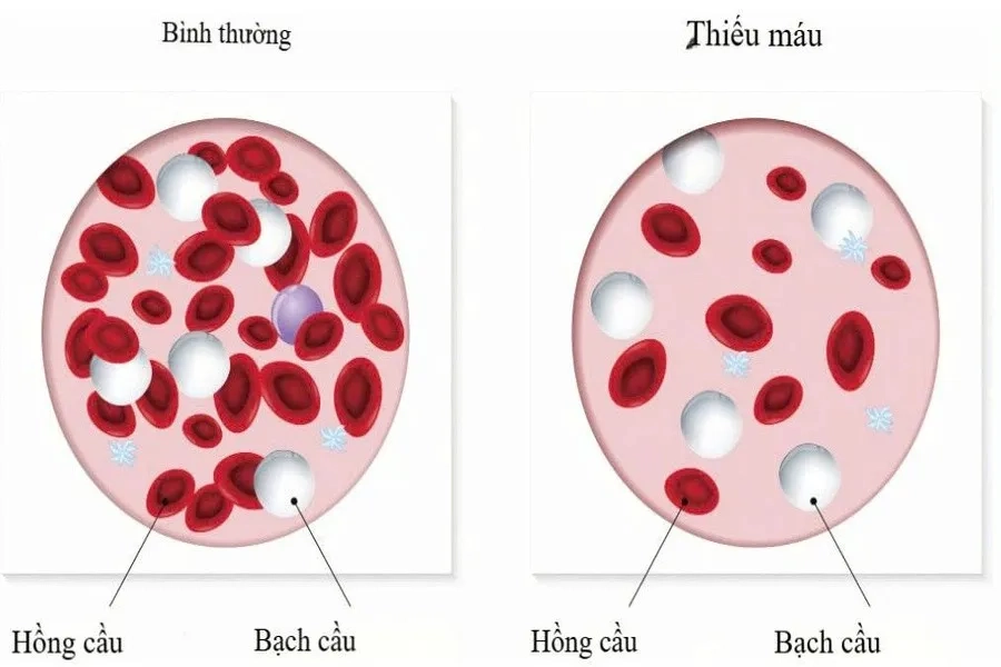 Thai Bị Thiếu Máu: Nguyên Nhân, Cách Chẩn Đoán Và Điều Trị An Toàn