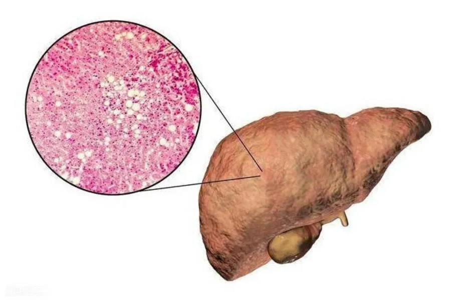 Gan Nhiễm Mỡ Không Do Rượu: Nguyên Nhân, Dấu Hiệu, Cách Điều Trị Mới Nhất 