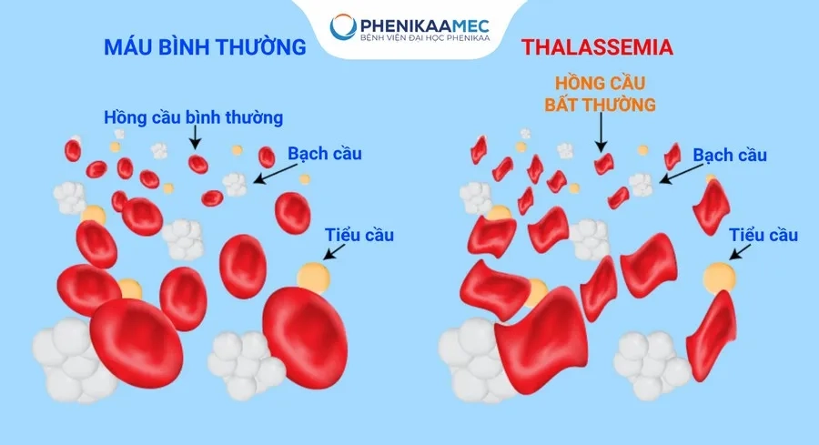 Bệnh tan máu bẩm sinh Thalassemia: Nguyên nhân, triệu chứng và cách điều trị
