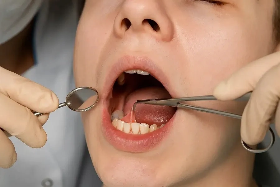 Dính thắng lưỡi: Dấu hiệu nhận biết sớm để điều trị kịp thời
