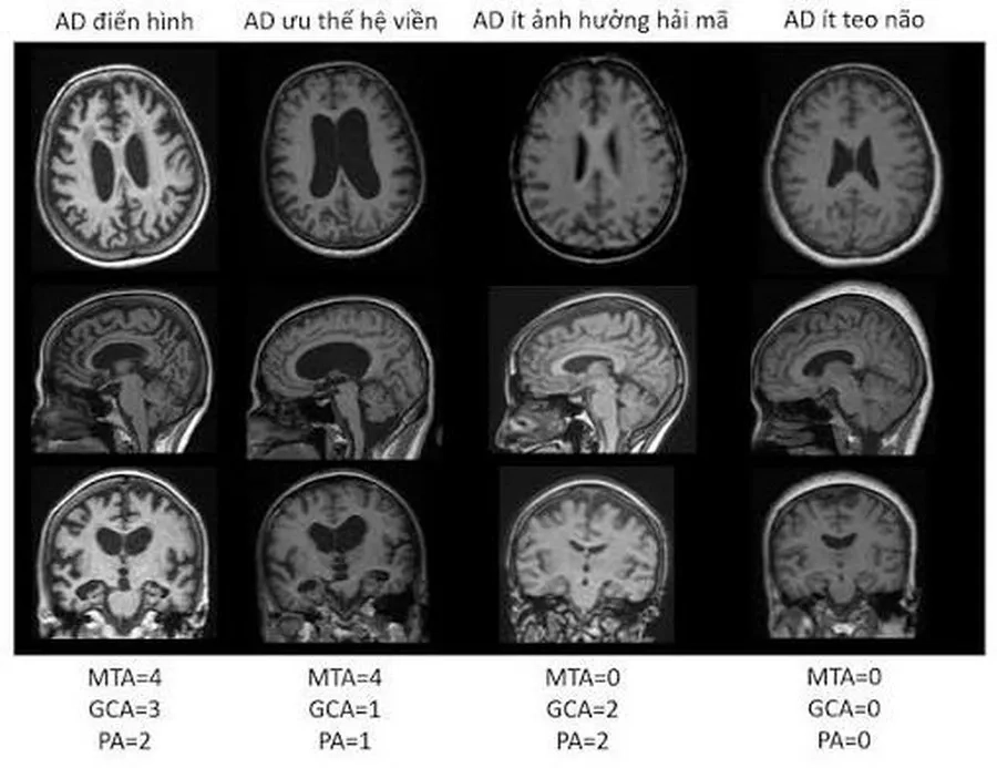 Chụp MRI Mạch Máu Não Chuyên Sâu: Phát Hiện Sớm Đột Quỵ, Phình Mạch Máu Não Và Nhiều Bệnh Lý Thần Kinh
