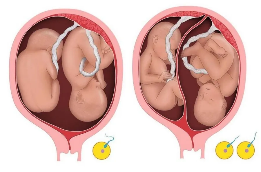 Sinh Đôi Là Gì? Những Điều Mẹ Bầu Cần Biết Khi Mang Thai Đôi