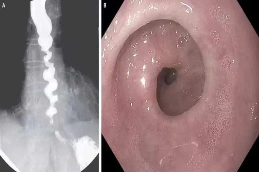 Co Thắt Tâm Vị (Achalasia) Là Gì? Nguyên Nhân, Triệu Chứng, Cách Điều Trị