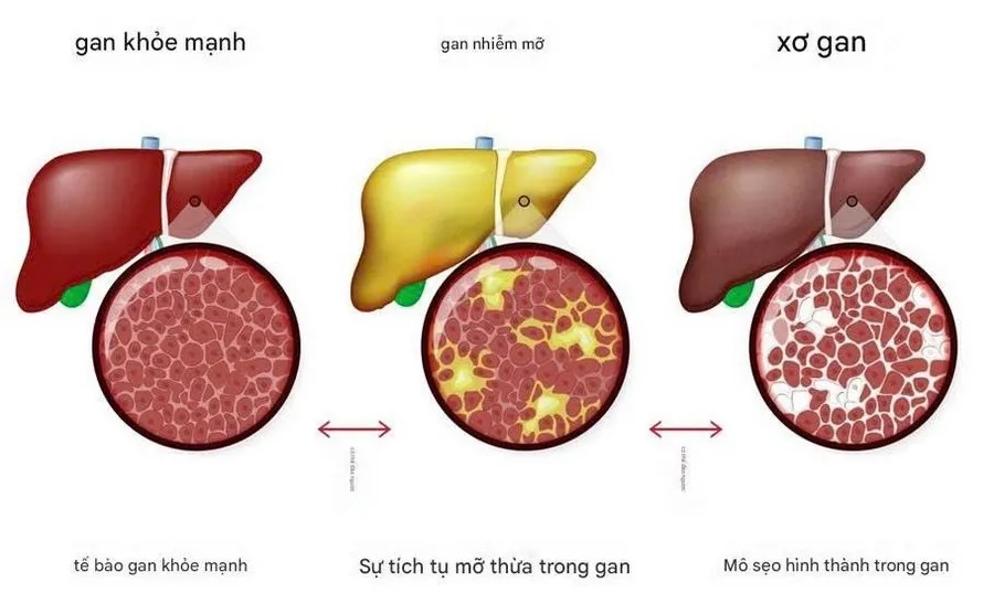Nguyên Nhân Gan Nhiễm Mỡ Là Gì? Phương Pháp Điều Trị Mới Nhất Hiện Nay 