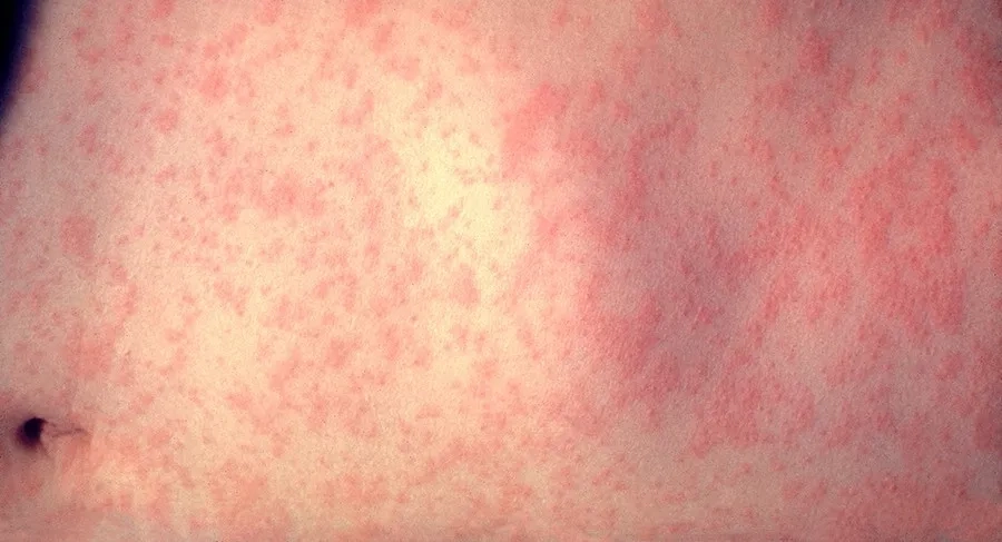 Bệnh sởi Đức (Rubella) là gì? Nguyên nhân, dấu hiệu nhận biết và cách phòng ngừa