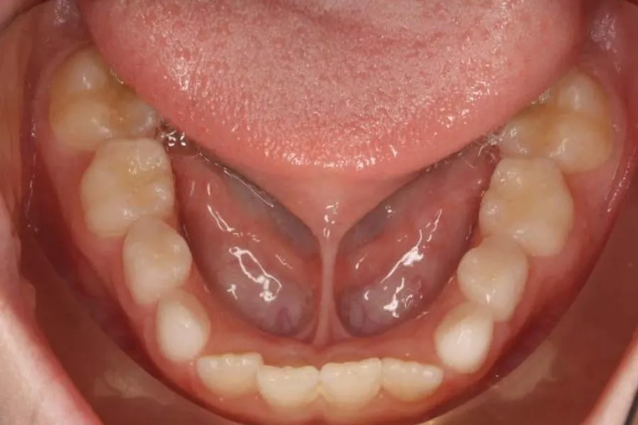 Trẻ dính thắng lưỡi độ 3 có cần cắt không? Lời khuyên từ chuyên gia