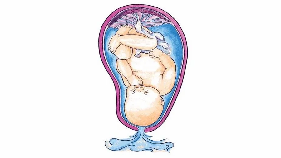 Vỡ ối mà tử cung chưa mở: Nguyên nhân, nguy cơ và cách xử lý