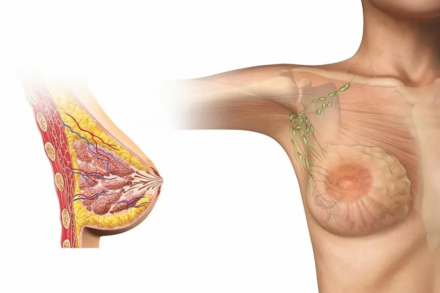 Ung Thư Vú Di Căn Có Chữa Được Không? Giải Đáp Từ Chuyên Gia