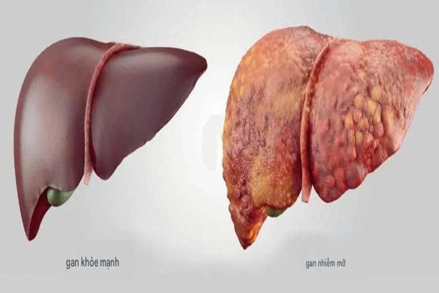 Gan Nhiễm Mỡ Độ 3: Nguyên Nhân, Dấu Hiệu, Phác Đồ Điều Trị