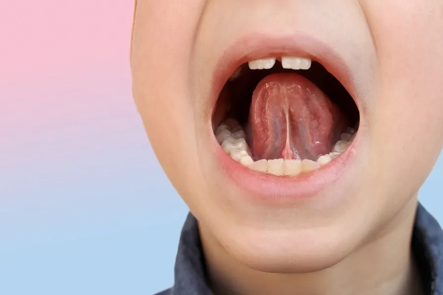 Dính thắng lưỡi độ 1 có cần cắt không và cách xử trí phù hợp