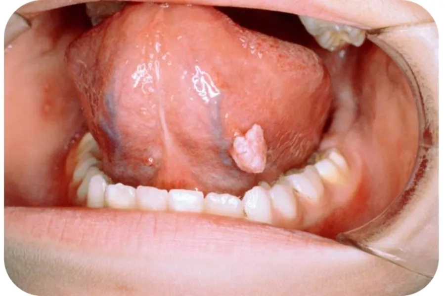 HPV Ở Miệng Là Gì? Dấu Hiệu Nhận Biết Và Cách Chữa Hiệu Quả Nhất Hiện Nay