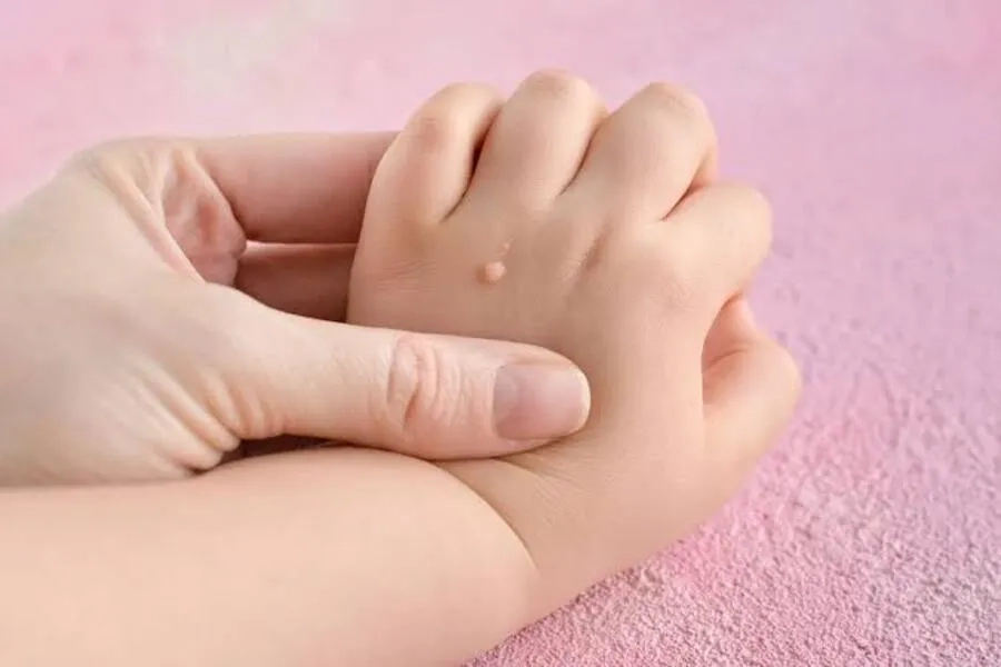Các đường lây truyền sùi mào gà trẻ em và cách phòng ngừa hiệu quả