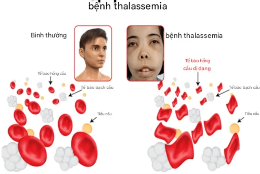 Nhận biết bộ mặt Thalassemia qua những biểu hiện điển hình