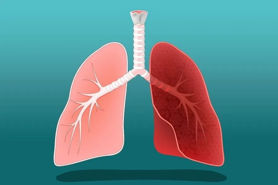 Viêm phổi kẽ: Nguyên nhân, triệu chứng, mức độ nguy hiểm và điều trị