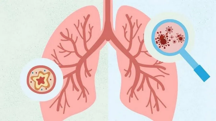 Phân biệt viêm phế quản và viêm phổi dựa trên các đặc điểm thường gặp