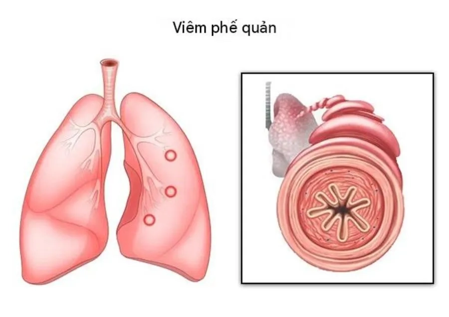 Viêm phế quản là gì? Những thông tin quan trọng cần biết về bệnh