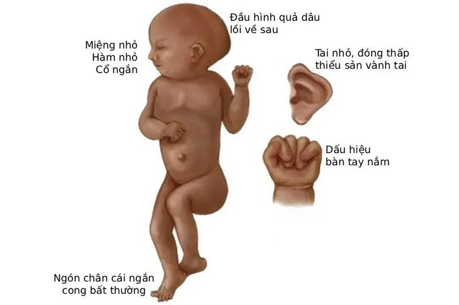 Hội Chứng Edwards Là Gì? Nguyên Nhân, Biểu Hiện Và Phương Pháp Phòng Ngừa
