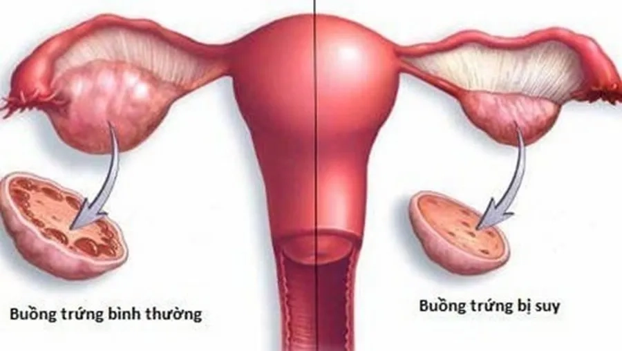 Hội chứng Triple X (47,XXX): dấu hiệu nhận biết sớm, nguyên nhân và khi nào cần làm xét nghiệm?