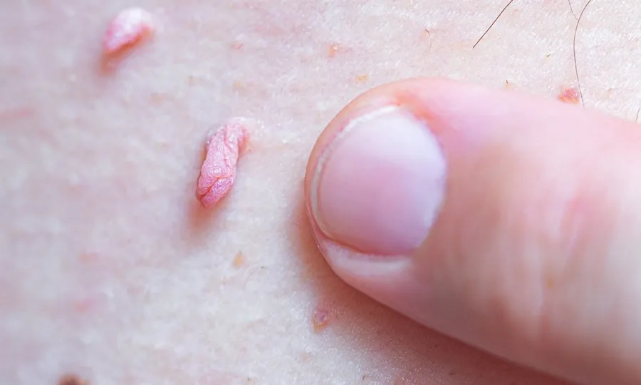 Dấu hiệu bệnh sùi mào gà: Cách nhận biết và thời điểm cần đi khám
