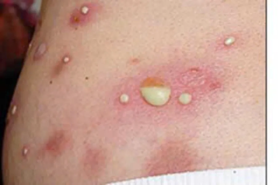 Viêm da mủ trẻ sơ sinh là bệnh nhiễm trùng da thường gặp